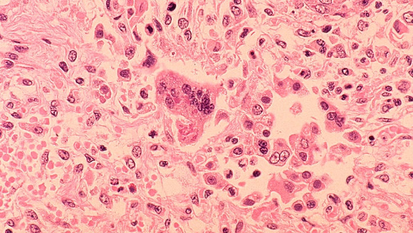 Texas measles outbreak linked to church