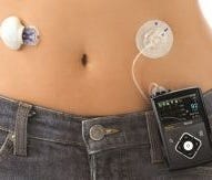 Medtronic's Minimed  diabetes treatment product.