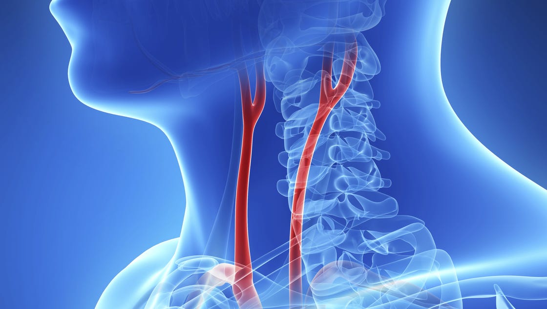 COOPER CONNECTION: Blocked carotid arteries lead to stroke
