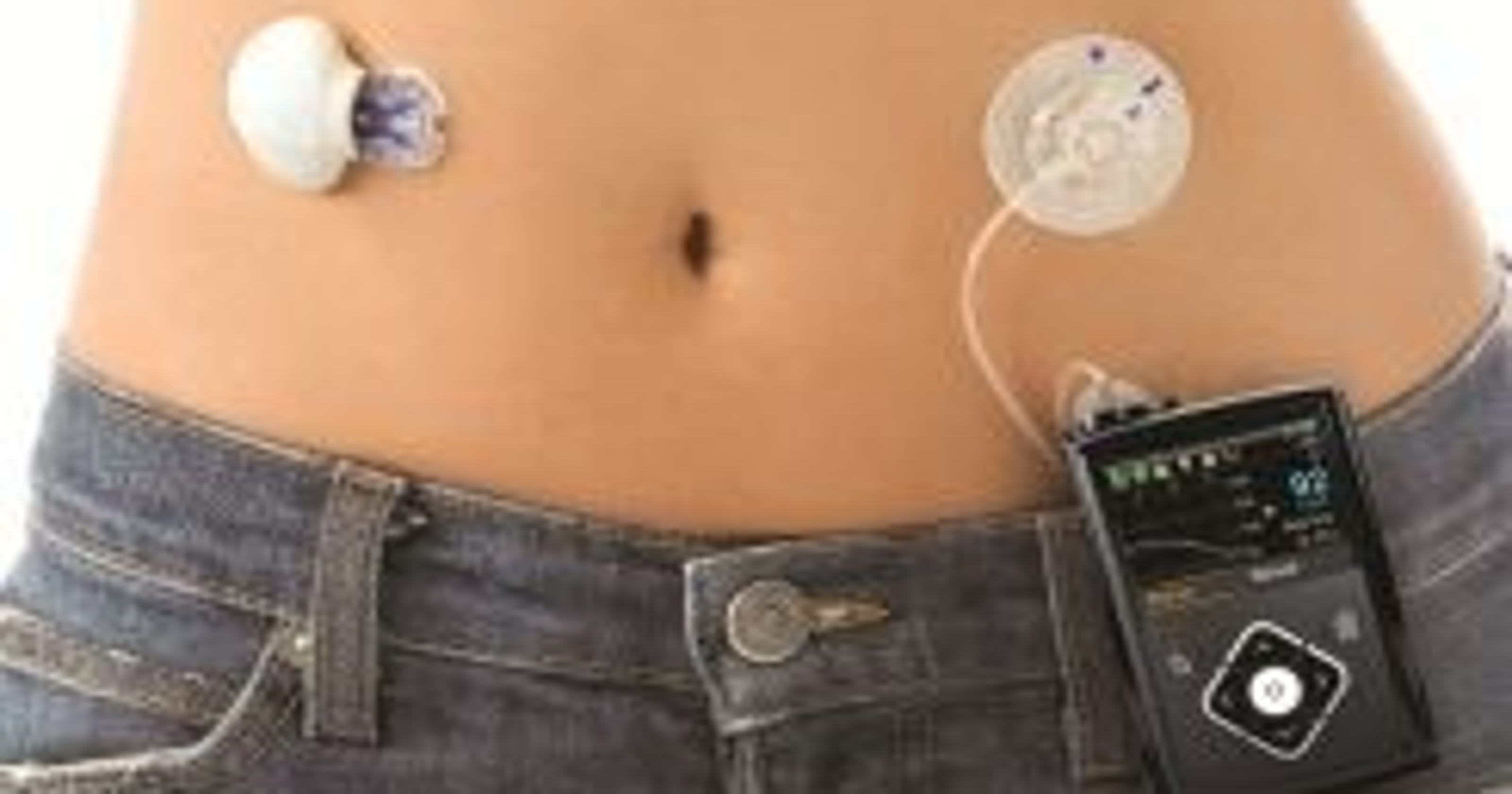 The first ‘artificial pancreas’ systems are coming to market