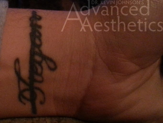 Advanced Aesthetics removes bad tattoo for free