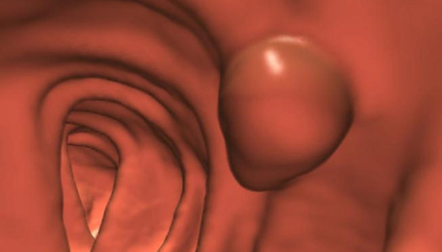 Colon cancer rates drop sharply due to screenings