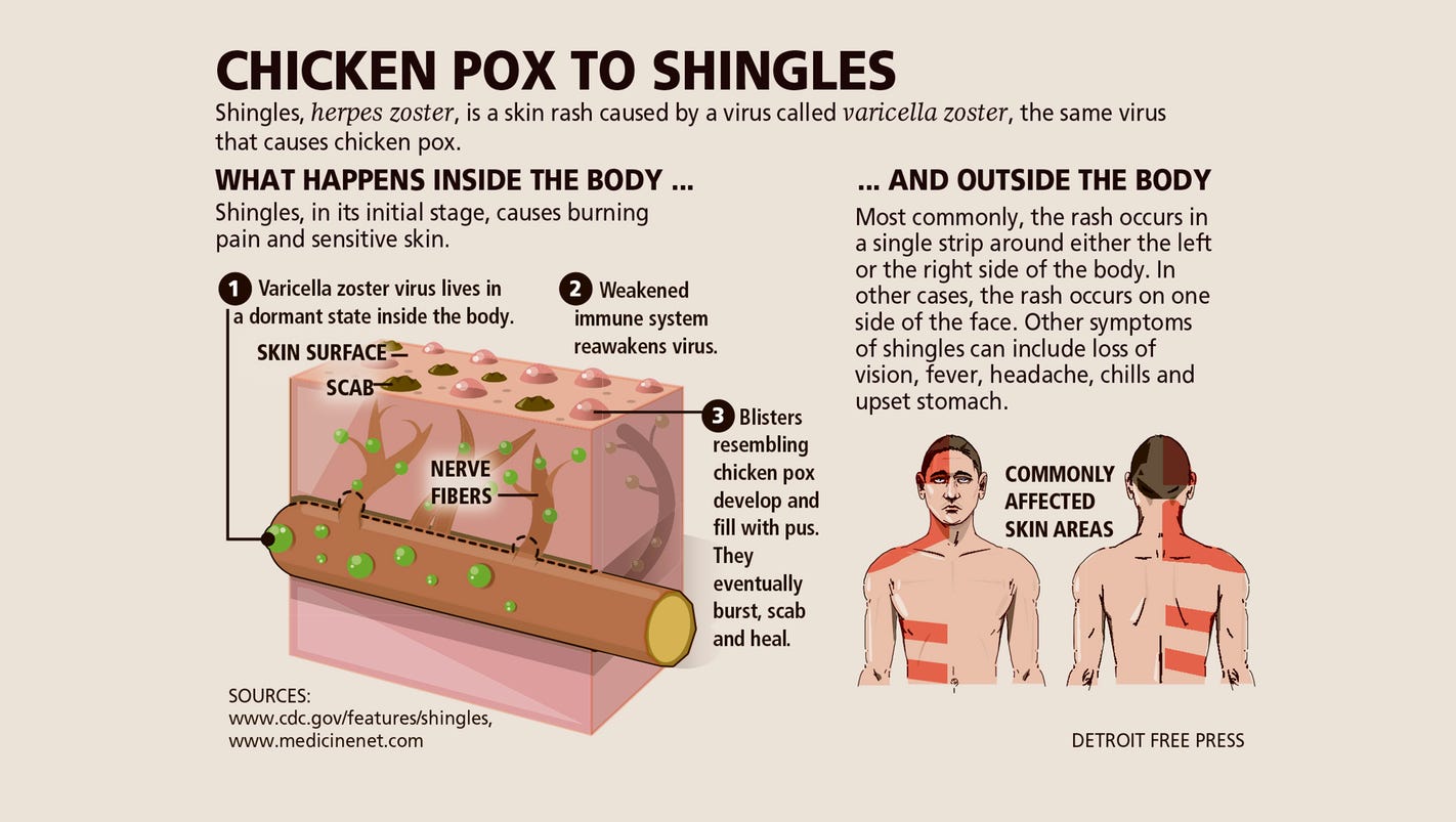 information about shingles