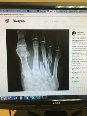 An X-ray on Kelly Slater's Instagram page from July 2017 shows his broken foot in South Africa.