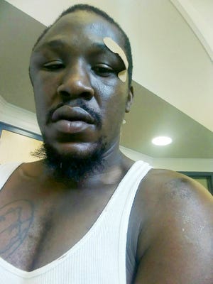 A photograph provided by Johnnie Rush shows his swollen head after an encounter with the Asheville Police Department in August 2017.