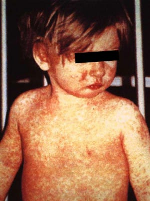 Child with a classic measles rash after four days.