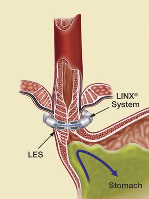 LINX consists of a small ring of interconnected magnets placed around the esophagus and works by restoring the strength of the esophagus’ sphincter.