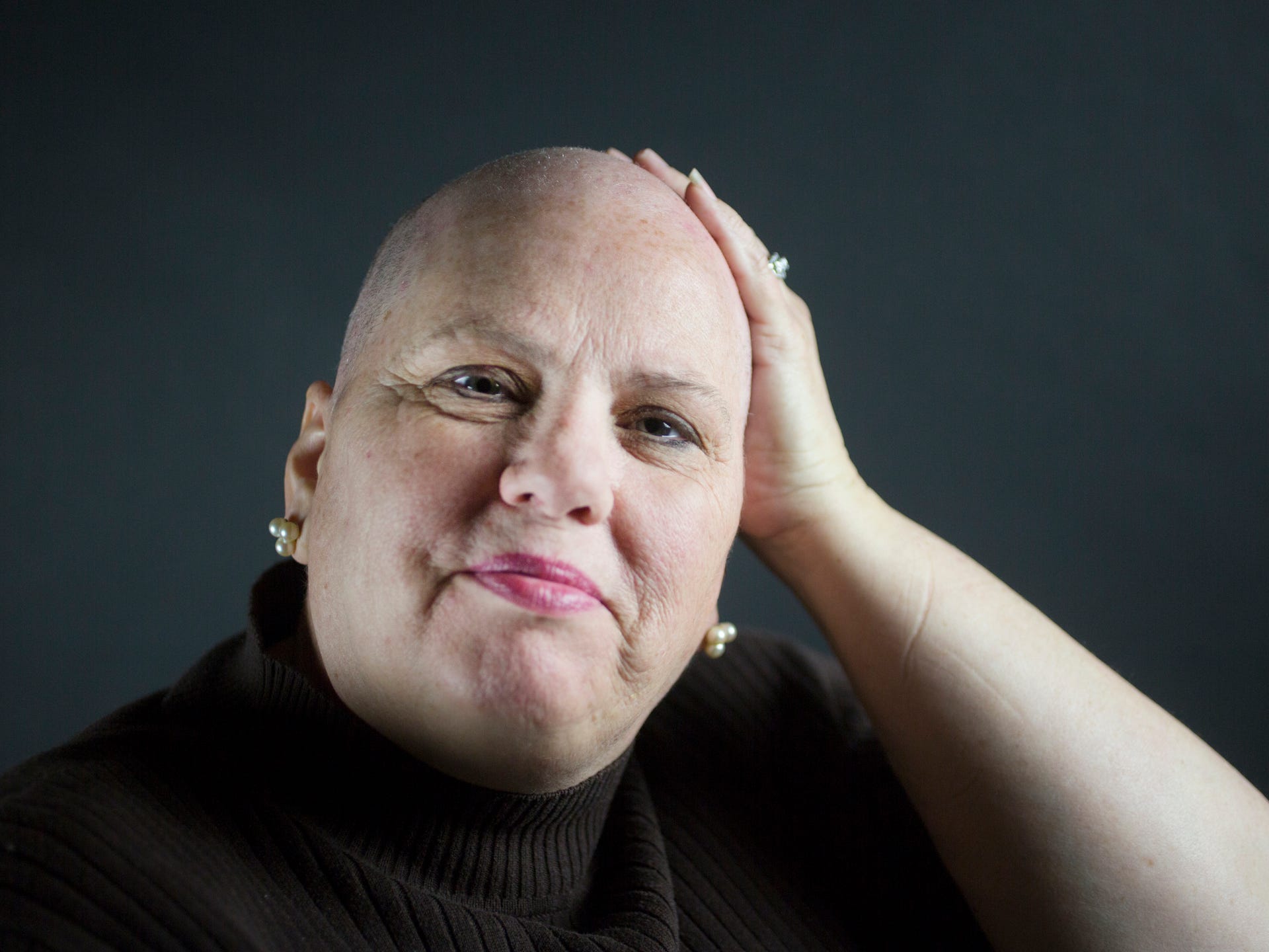 Breast Cancer Survivors Struggle With Hair Loss