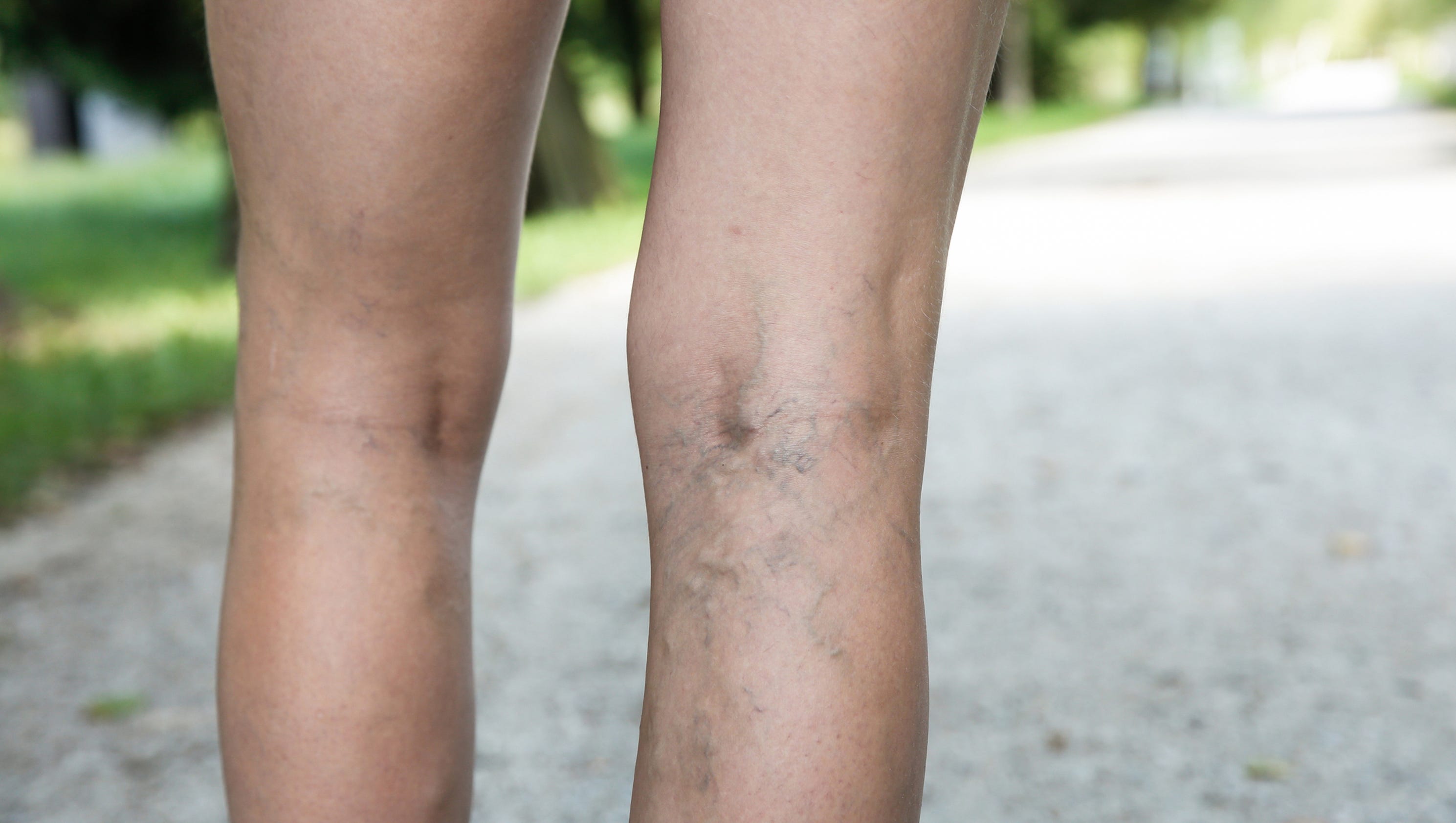 Treatment options for varicose veins