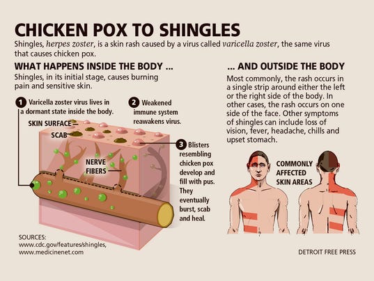 pictures of shingles rash