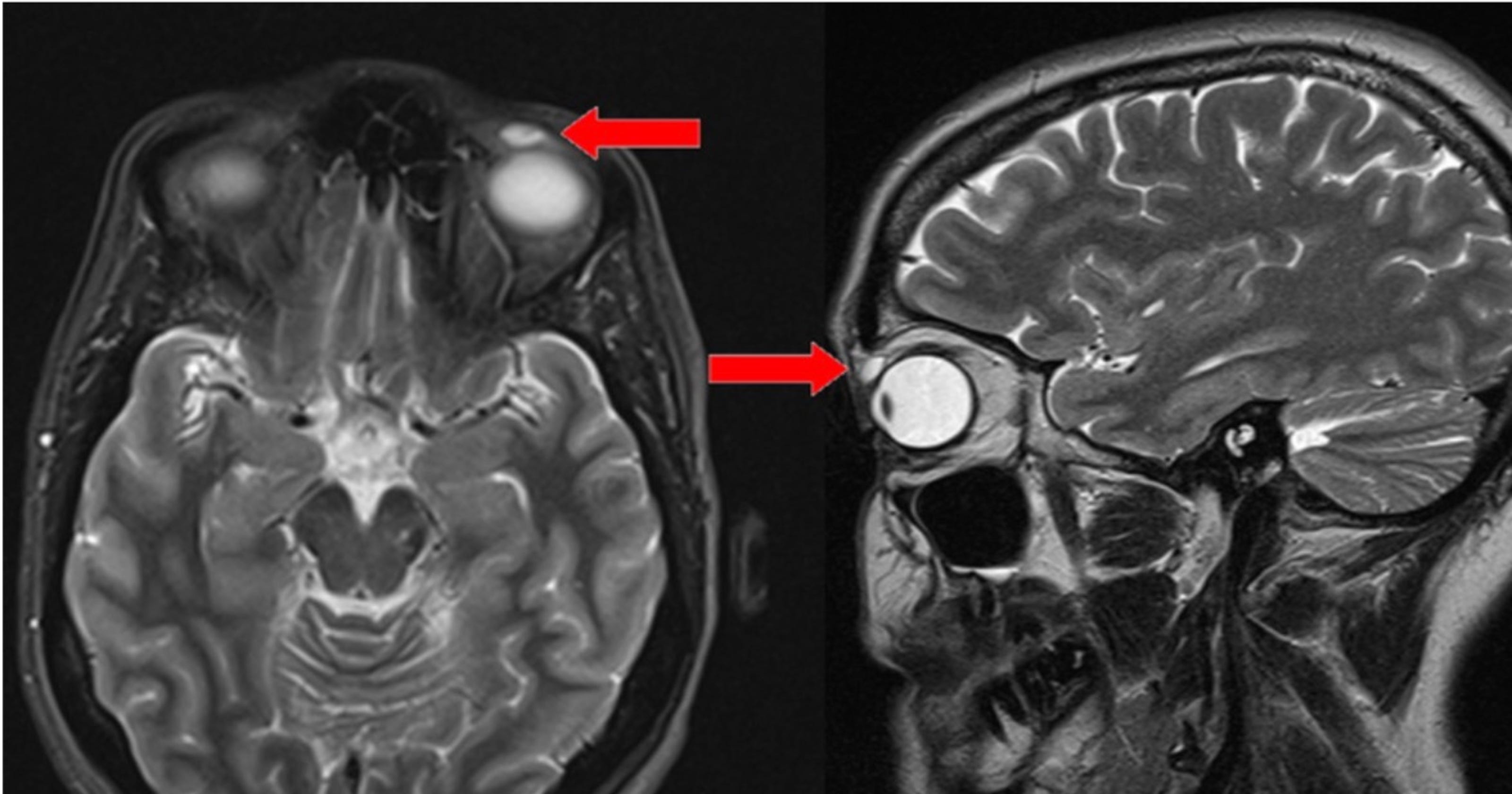 Contact lens stuck in woman's eye for 28 years, British doctors report