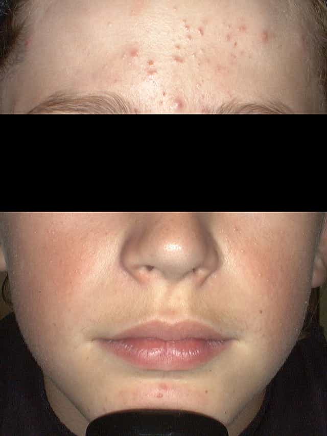 Kids Are Getting Acne Younger Than Ever Doctors Say