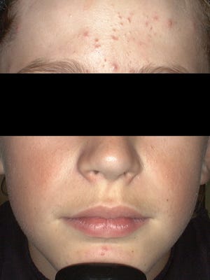 Kids Are Getting Acne Younger Than Ever Doctors Say Kids Are Getting Acne Younger Than Ever Doctors Say