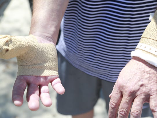 Steve Verschoor, 54, shows his bite wounds after a