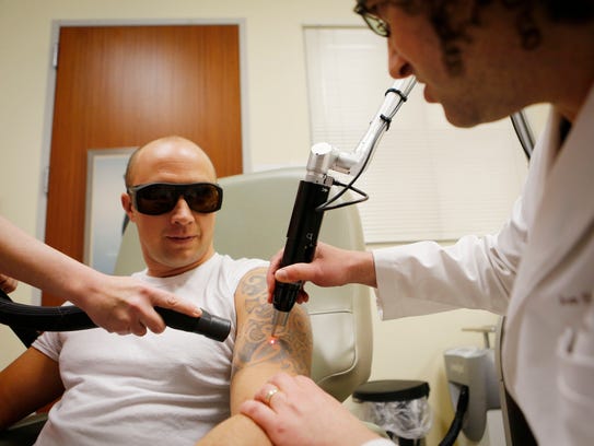 Tattoo removal takes a laser leap forward