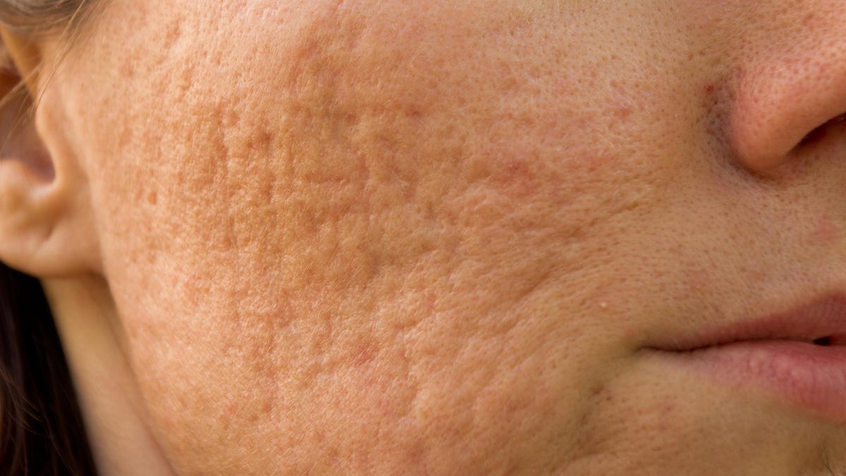 Go pimples on away won t forehead Skin cancer,