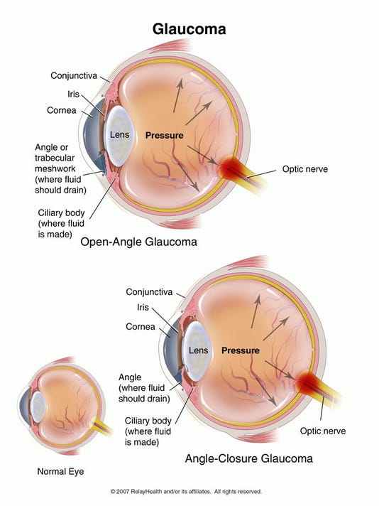 Glaucoma A Leading Cause Of Blindness