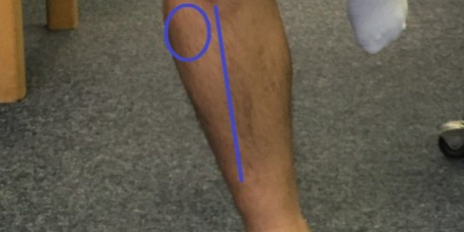 The Injury Zone Diagnosing Anterior Shin Splints