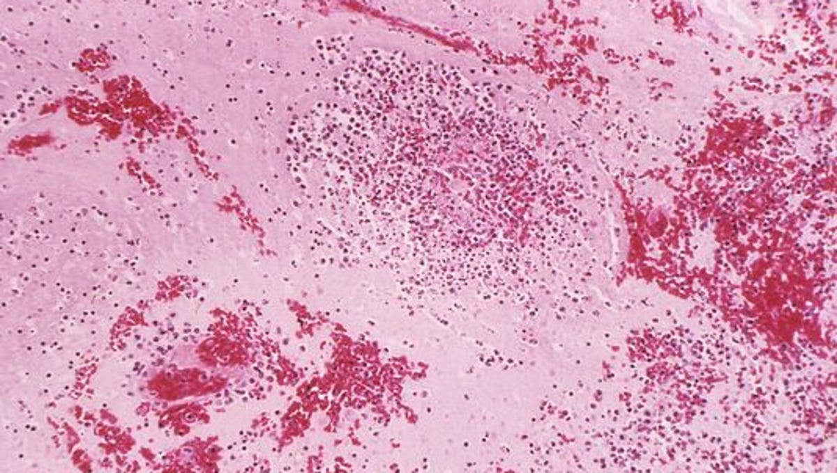 Bubonic Plague Case Confirmed In Michigan