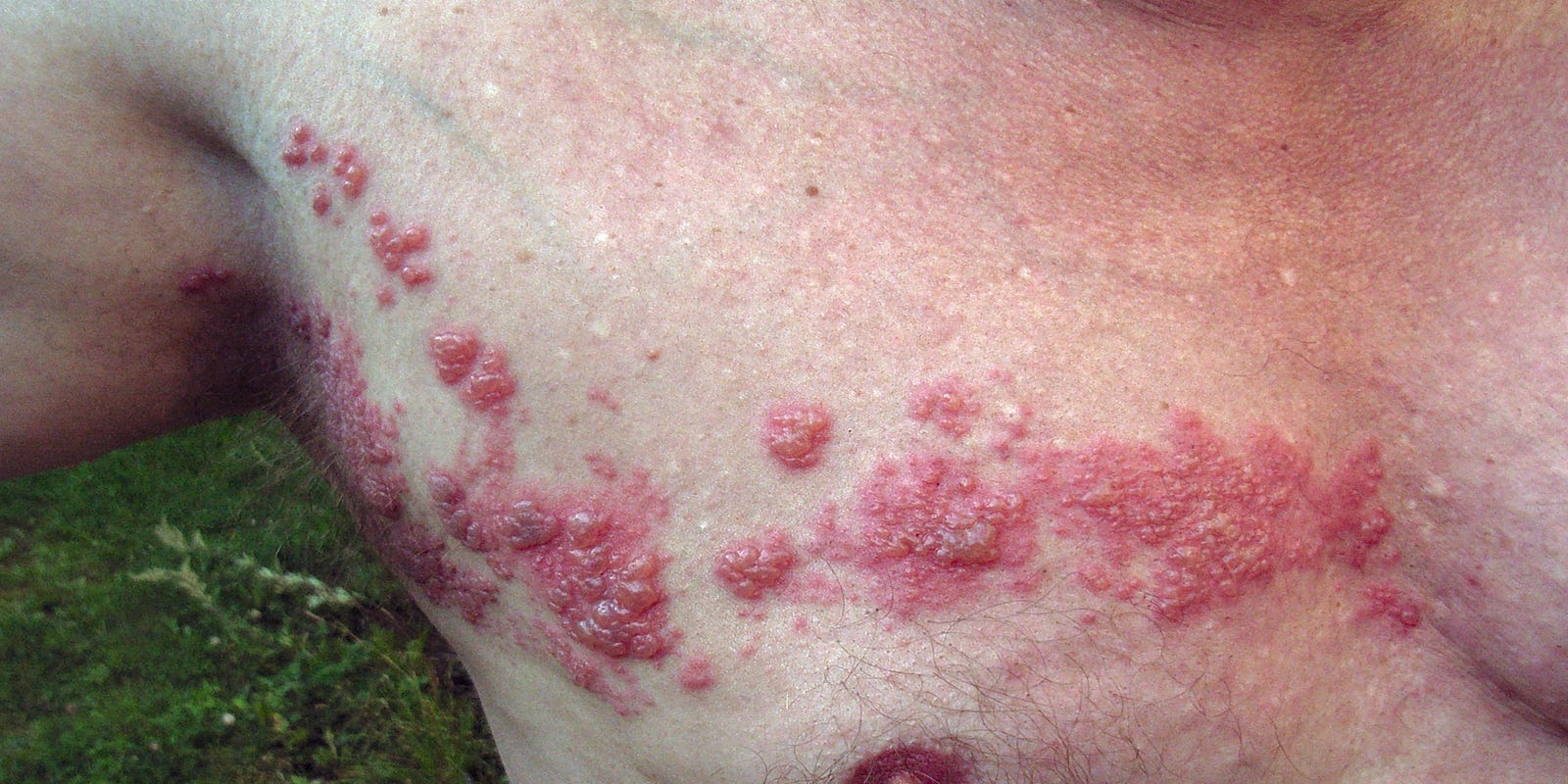 Herpes May Lay Dormant For Years