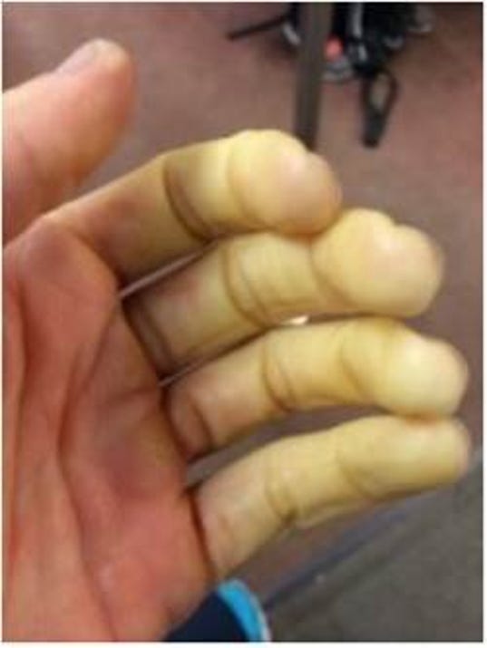 Littleknown condition makes the cold even more brutal