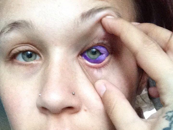 Catt Gallinger, a pet nurtrionist and aspiring model from Canada, needs to remove purple ink from her eye after her scleral tattoo 
