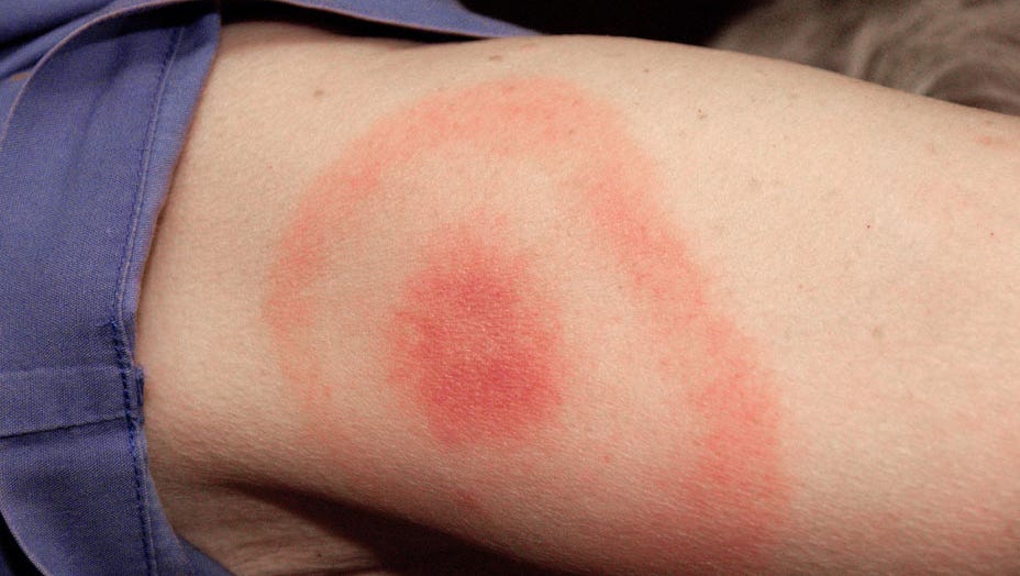 Lyme Disease Better Test Needed Federal Panel Argues