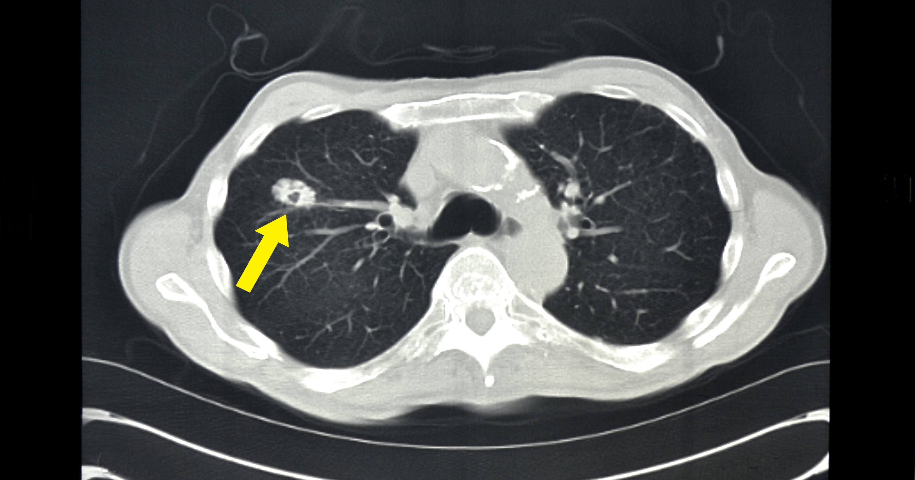 Signs Of Lung Cancer