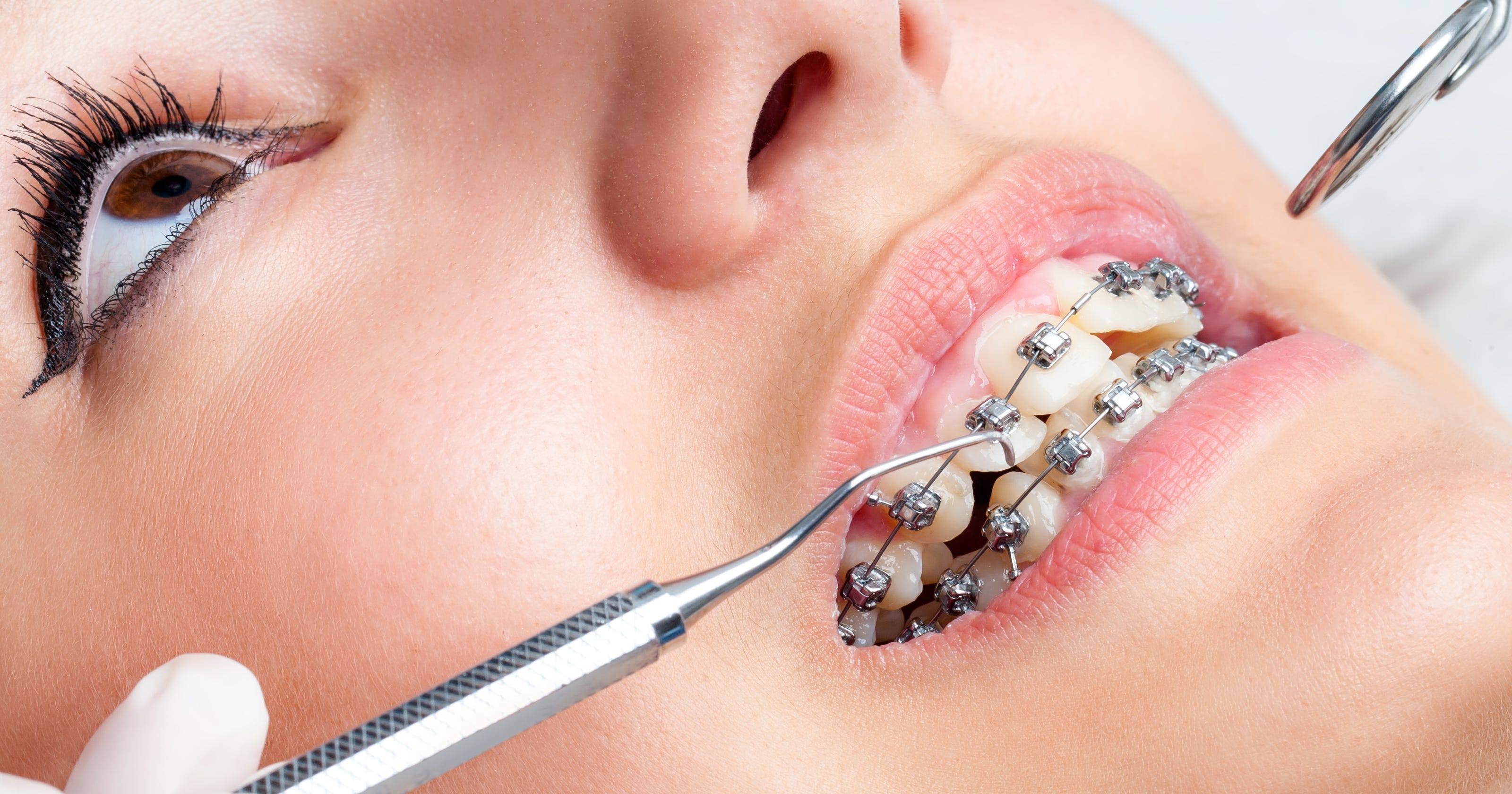 A woman looking up with braces