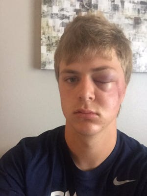 Rider senior David Moffat was hit by a pitch just below his left eye last summer.
