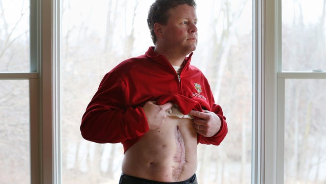 Kevin Flannery shows the aftermath left on his body after being shot by a high-powered rifle while he was mowing a path in his field behind his Parma home.