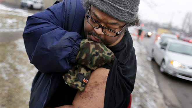 Flint resident Robert Jackson, 54, shows of some marks left on his arm that he believes are the result of drinking contaminated Flint tap water at Flint Fire Station 3 in Flint, on Thursday, Jan. 21, 2016.