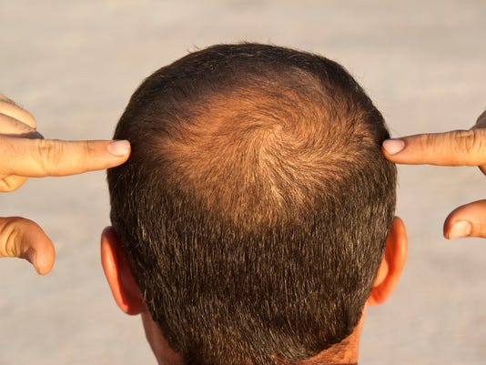 Baldness An Osteoporosis Drug Could Help Grow Hair