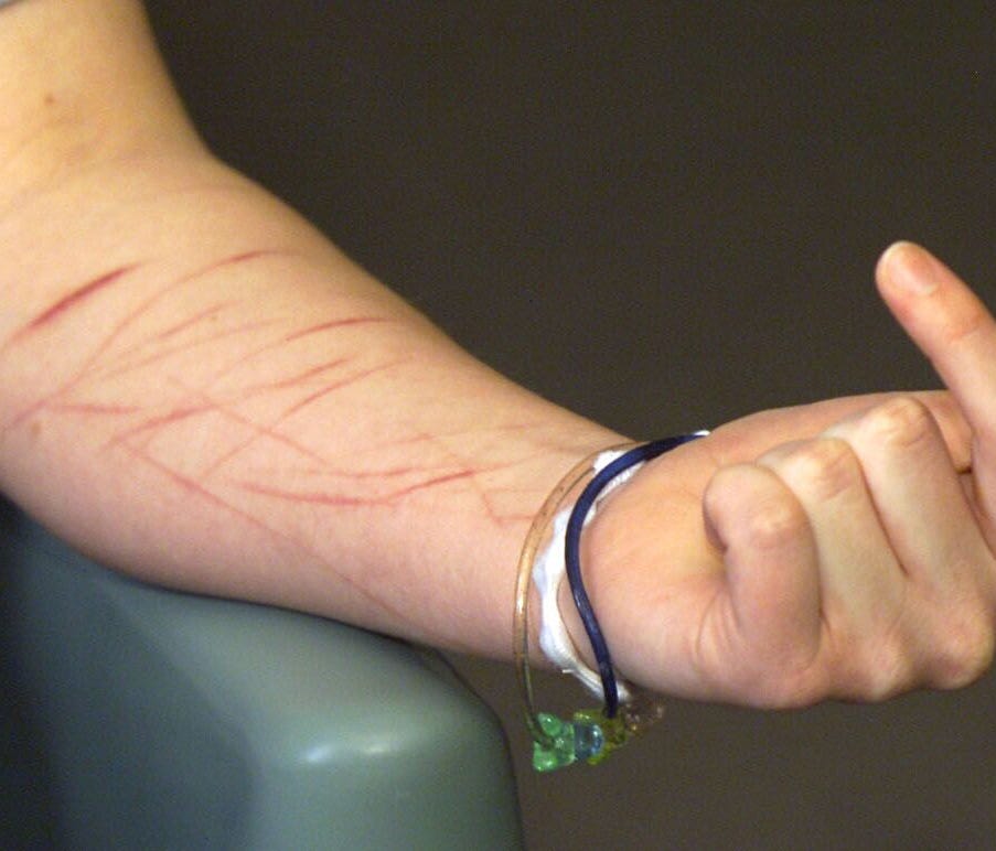 Self-mutilation scars