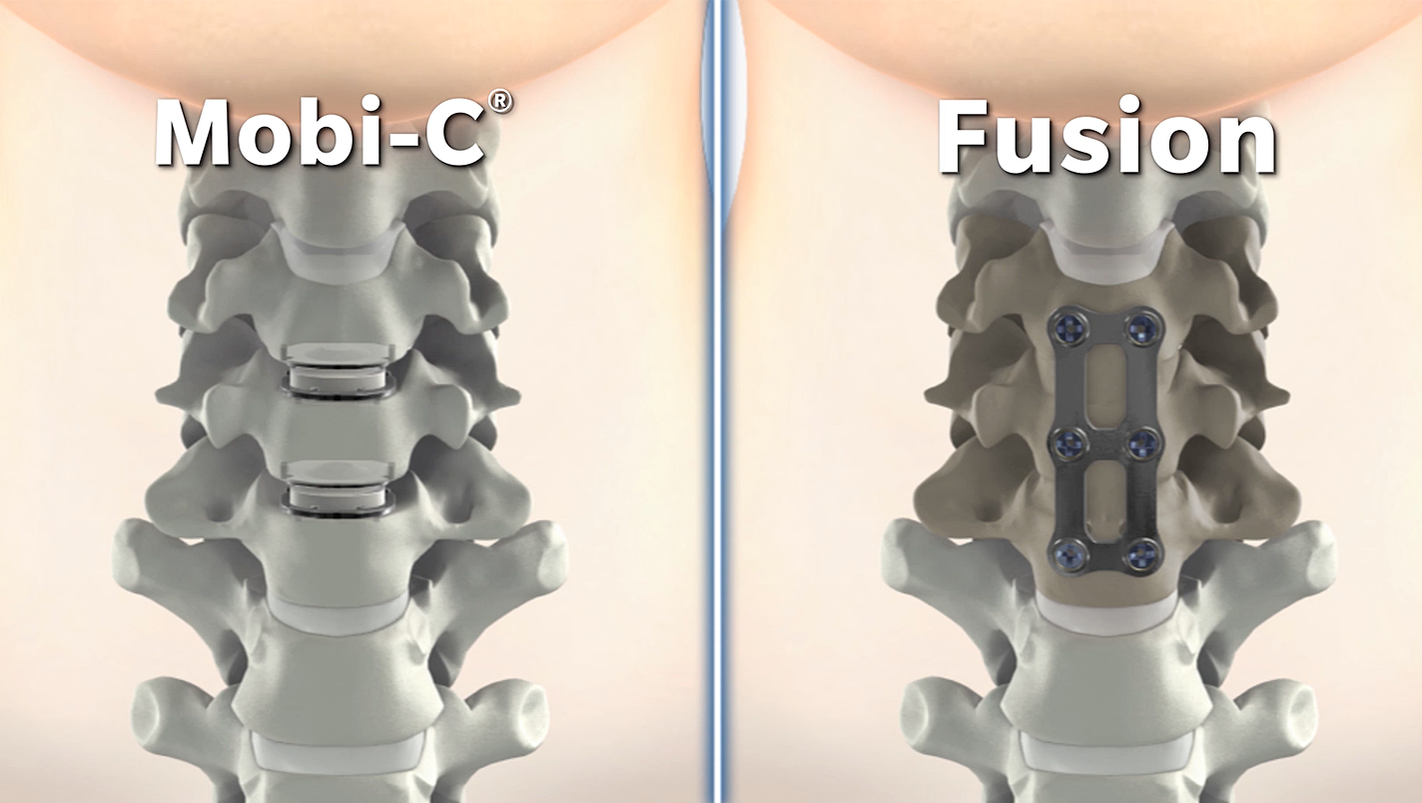 New procedure improves cervical spine surgery