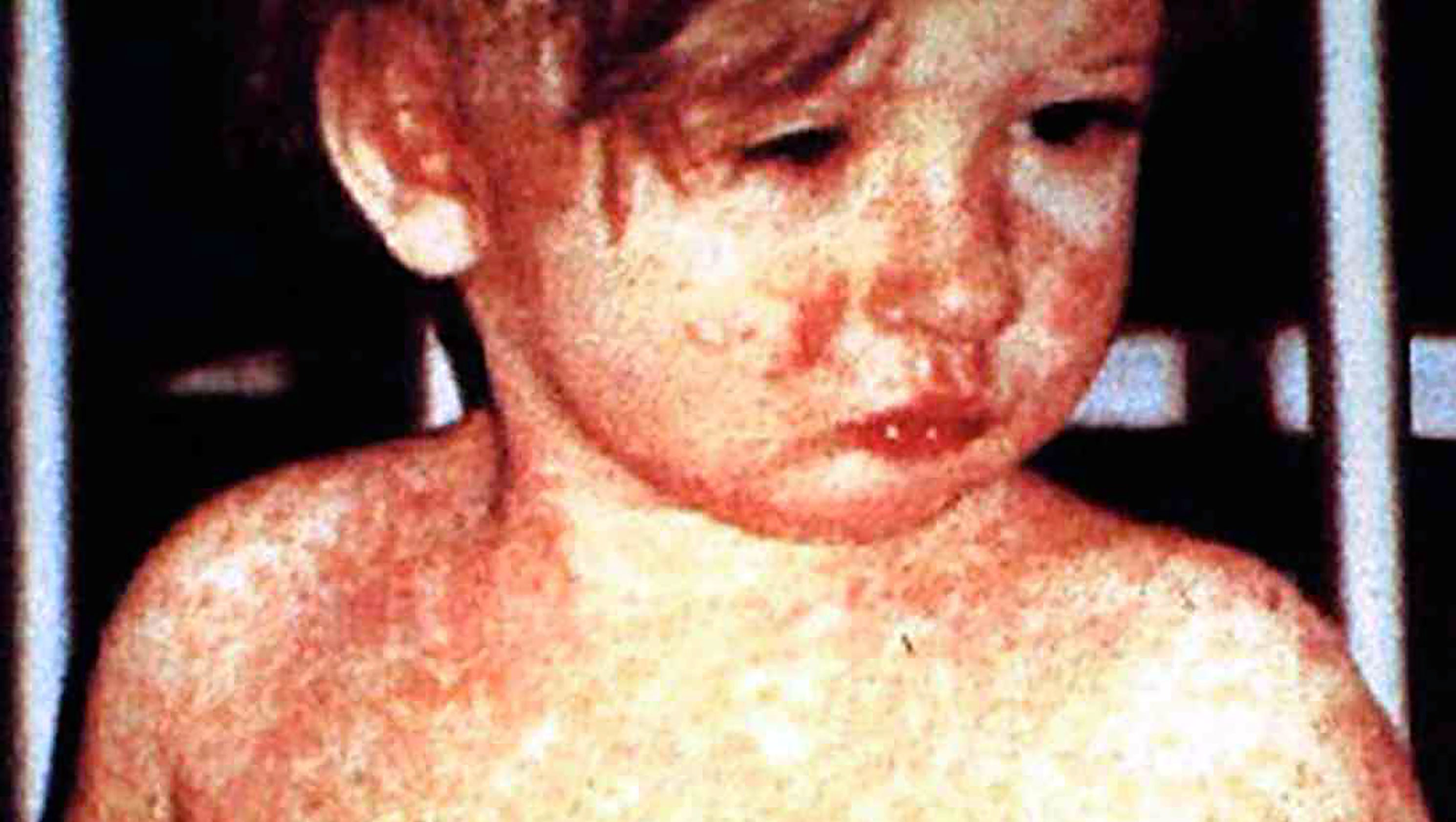 Measles: Passengers expose fellow travelers at 3 airports to virus