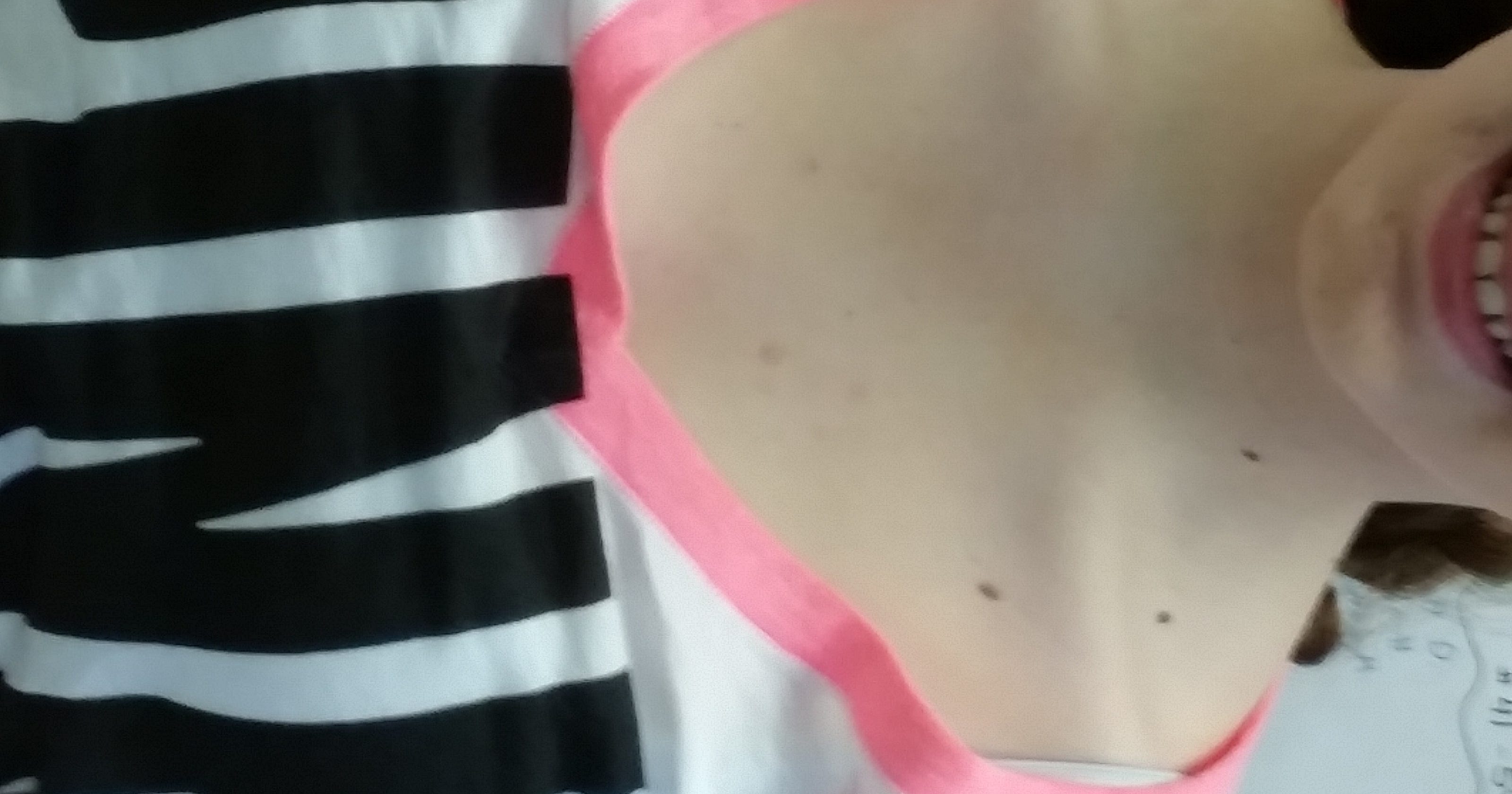 Why Do Redheads Sunburn So Easily