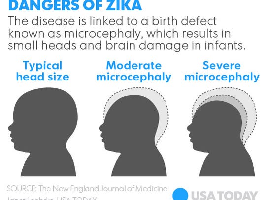 Baby with Zika-linked microcephaly born in Texas