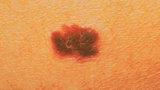 Melanoma, a deadly skin cancer, can begin as a new small, pigmented skin growth on normal skin. Unlike other forms of skin cancer, melanoma readily spreads to different parts of the body, where it continues to grow and destroy tissue.