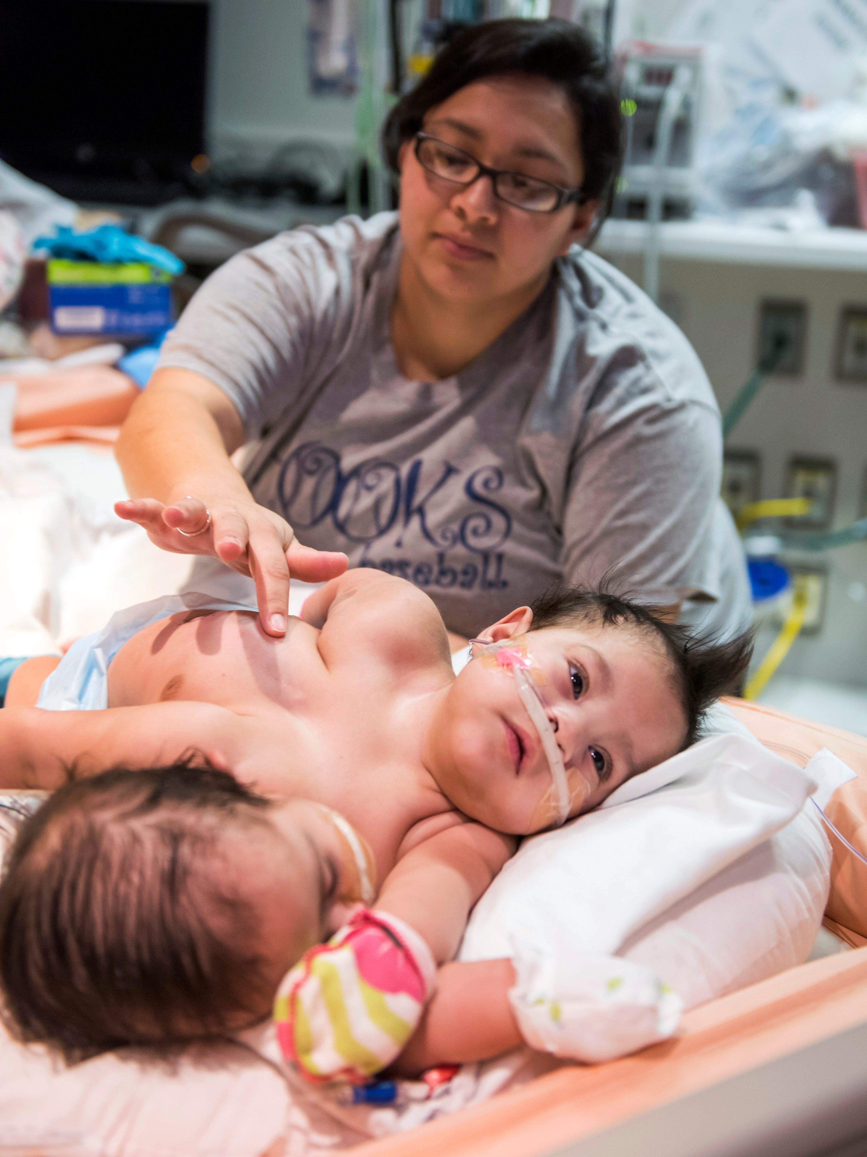 HOUSTON — Ninemonthold conjoined twins are getting ready for surgery