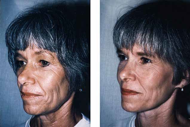 FILE--Undated file photos of identical twin sisters Gay Block, left, and Gwen Sirota. When they hit age 60, they thought they still looked alike. Then a plastic surgeon stunned them with side-by-side photographs: Despite having the same genes, Block actually looked much older than Sirota.