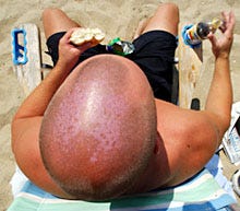 Mike Shea, 33, of Cotuit shaves his head every summer to keep it cooler. On a lunch break at Craigville Beach, he said he'd rub sun-protection lotion on his head when he started to burn.