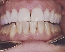 Bleaching uses peroxide to lighten tooth enamel. In this example, a patient has had her upper teeth treated with a 22 percent preparation of peroxide using a custom-fitted tray under a dentist's supervision. The lower jaw has not been treated