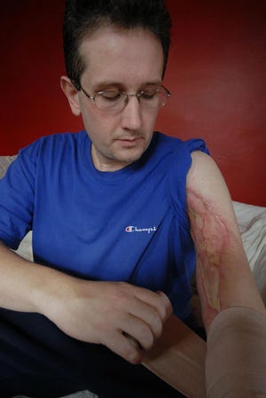 Stephen McCarroll, 40, of Norwich wraps his upper arm Wednesday, October 31, 2007 just weeks after surgery for the flesh eating virus called necrotizing fasciitis.