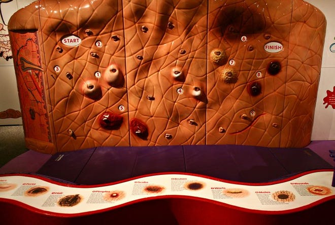 Climbers must brave scabs, pimples and blisters to reach the top of a wall resembling skin at the "Grossology: The (Impolite) Science of
the Human Body" exhibit.
