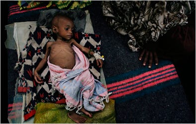 Above, a severely malnourished baby lay unresponsive on Thursday as the mother and father sat nearby in a feeding center in Afgooye, Somalia.