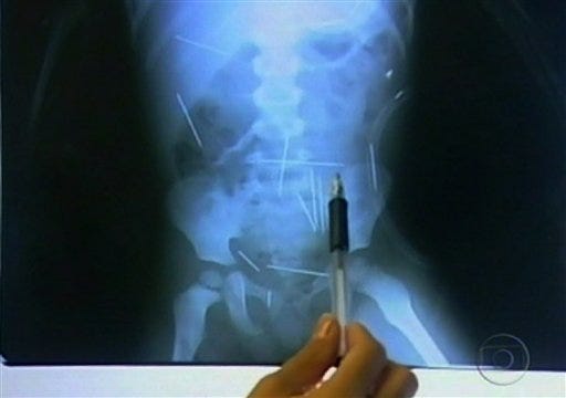 In this frame taken from a TV Globo video, a person points at a X-ray of a 2-year-old boy showing needles inside his body in a hospital in Ibotirama, northern Brazil, Tuesday, Dec. 15, 2009. A 2-year-old Brazilian boy has as many as 50 metal sewing needles inside his body and a doctor treating the boy said they were apparently stuck there one by one.