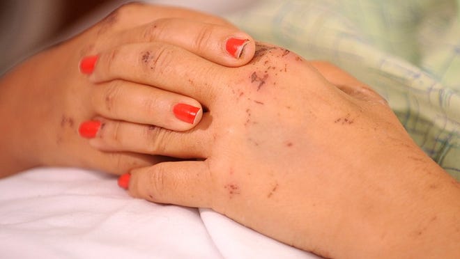 Bruises on Mireille Dittmer's hand who was air lifted to Boca Raton Community Hospital, after being trapped for 5 days in a grocery store in Haiti.