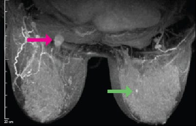 Aurora Dedicated Breast MRI is an invaluable tool in planning treatment for breast cancer. This MRI image shows a patient who was diagnosed with a cancer close to the chest wall in her right breast, as well as a separate cancer in her left breast. The MRI was useful in planning neoadjuvant chemotherapy (done prior to surgery) to shrink the tumor in the right breast and improve the outcome of breast conservation.