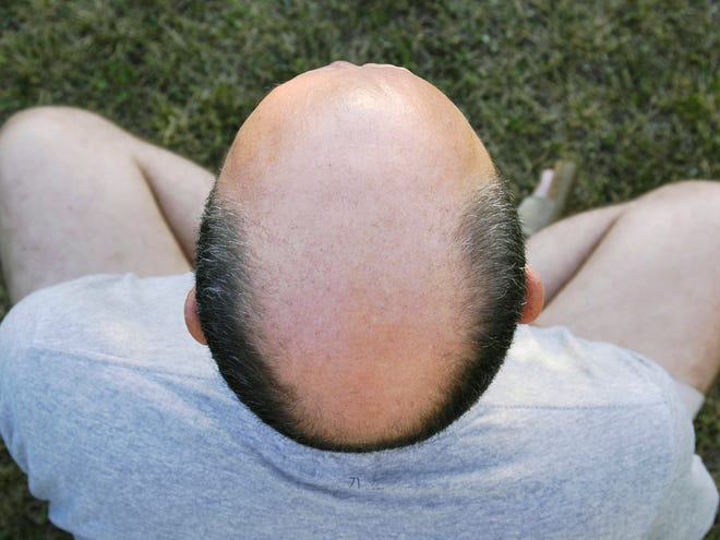 Researchers found that a bald scalp contains as many stem cells as a scalp with hair, suggesting that stimulating the cells may result in hair growth. (istockphoto.com)